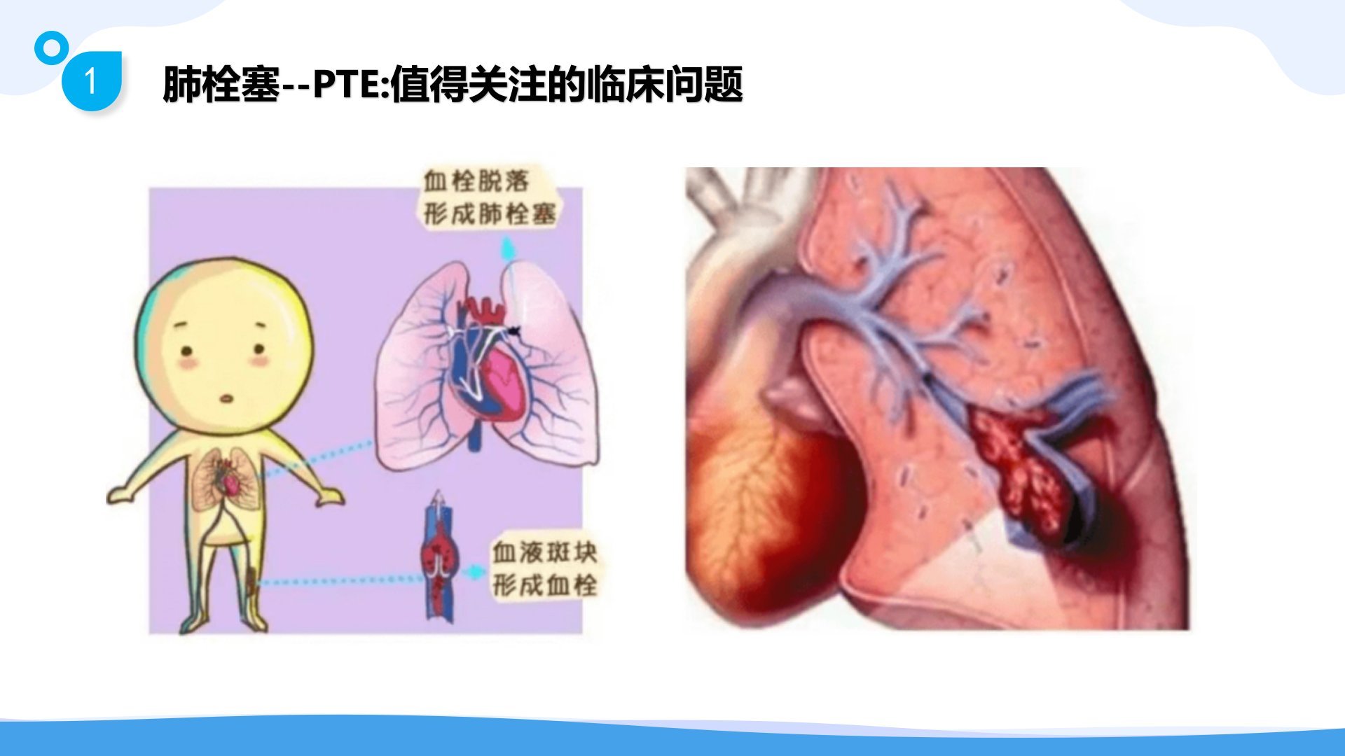 图片[9]-静脉血栓栓塞症(VTE)的-预防与护理 PPTx(共72 页)-医护资料网